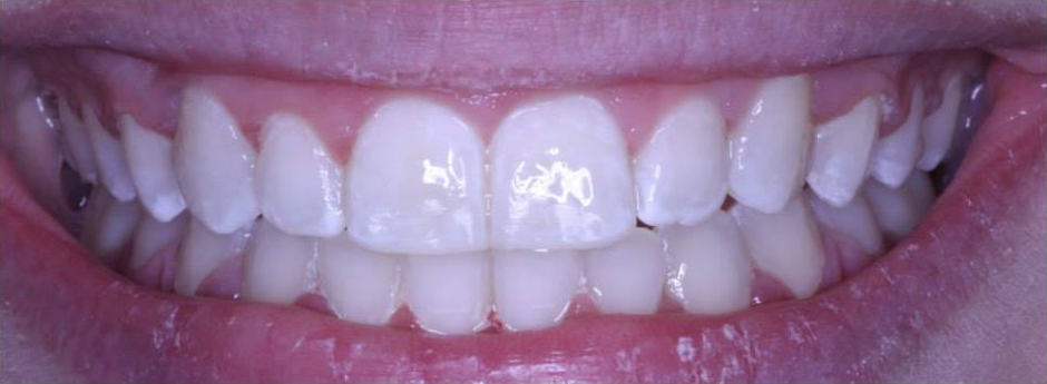 Close-up of person's teeth after cosmetic dentistry.