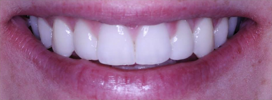 Close-up of person's teeth after cosmetic dentistry.
