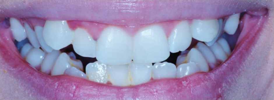Close-up of person's teeth before cosmetic dentistry.