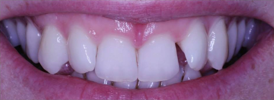 Close-up of person's teeth before cosmetic dentistry.