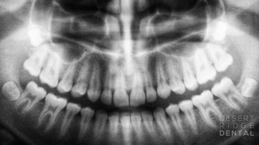 Dental x-ray of patient's mouth