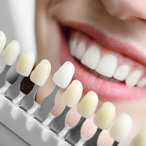 Dental veneer samples being held up to woman's mouth for color matching.