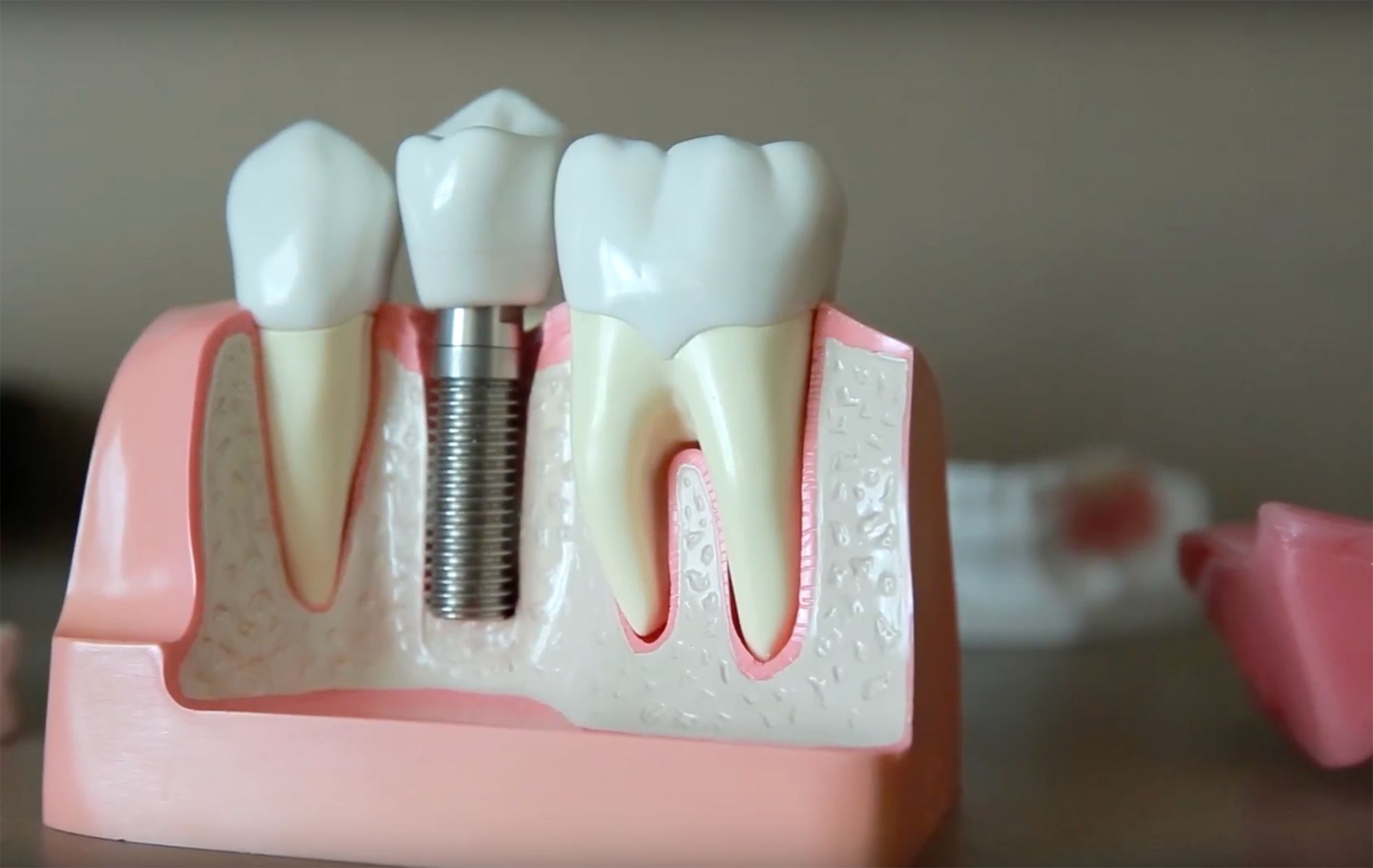 Virtual Consult Quiz (Implants) Desert Ridge Dental