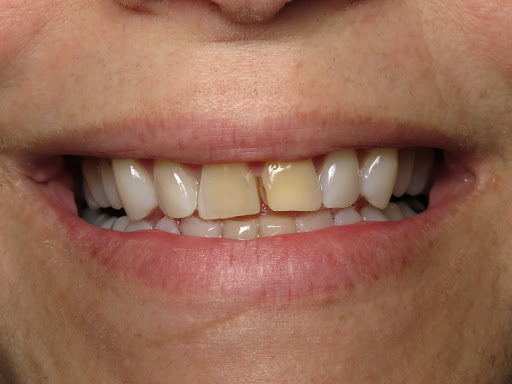 Patient's mouth before teeth whitening.