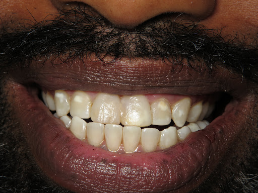 Patient's mouth after teeth whitening.