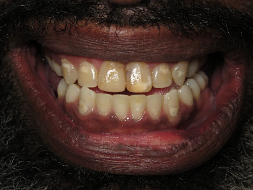 Patient's mouth before teeth whitening.