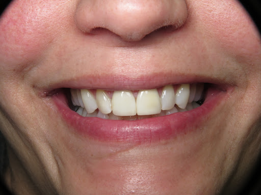 Patient's mouth after teeth whitening.