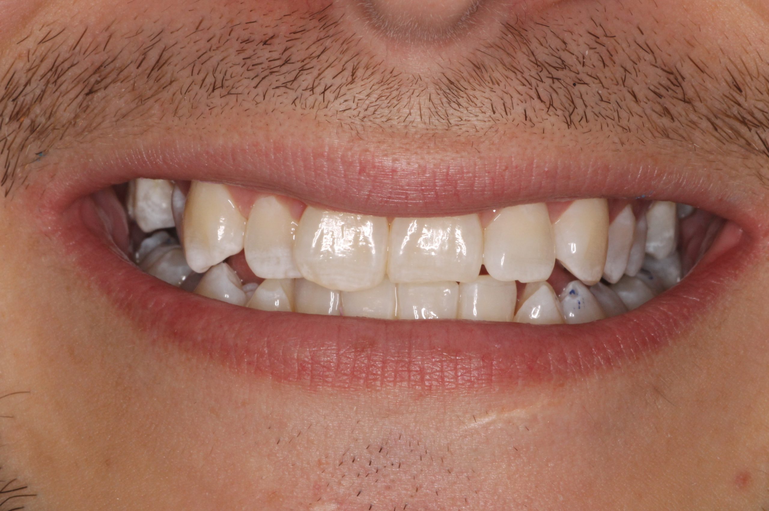 Closeup of man's mouth before braces.