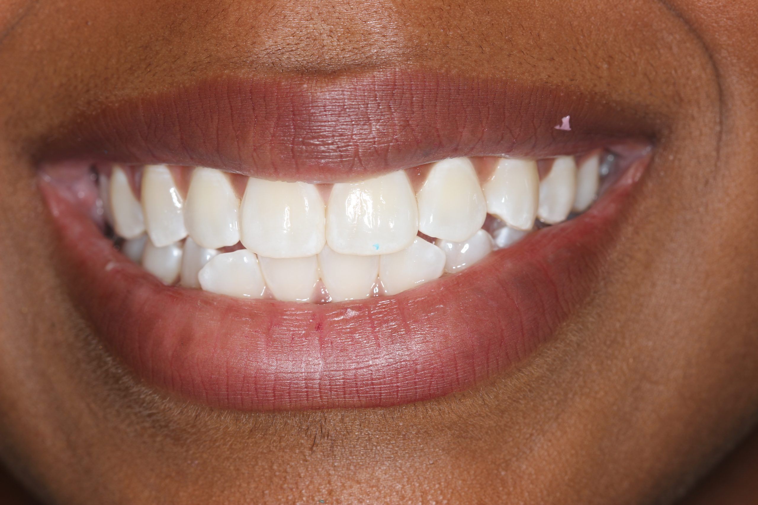 Patient's mouth before braces.