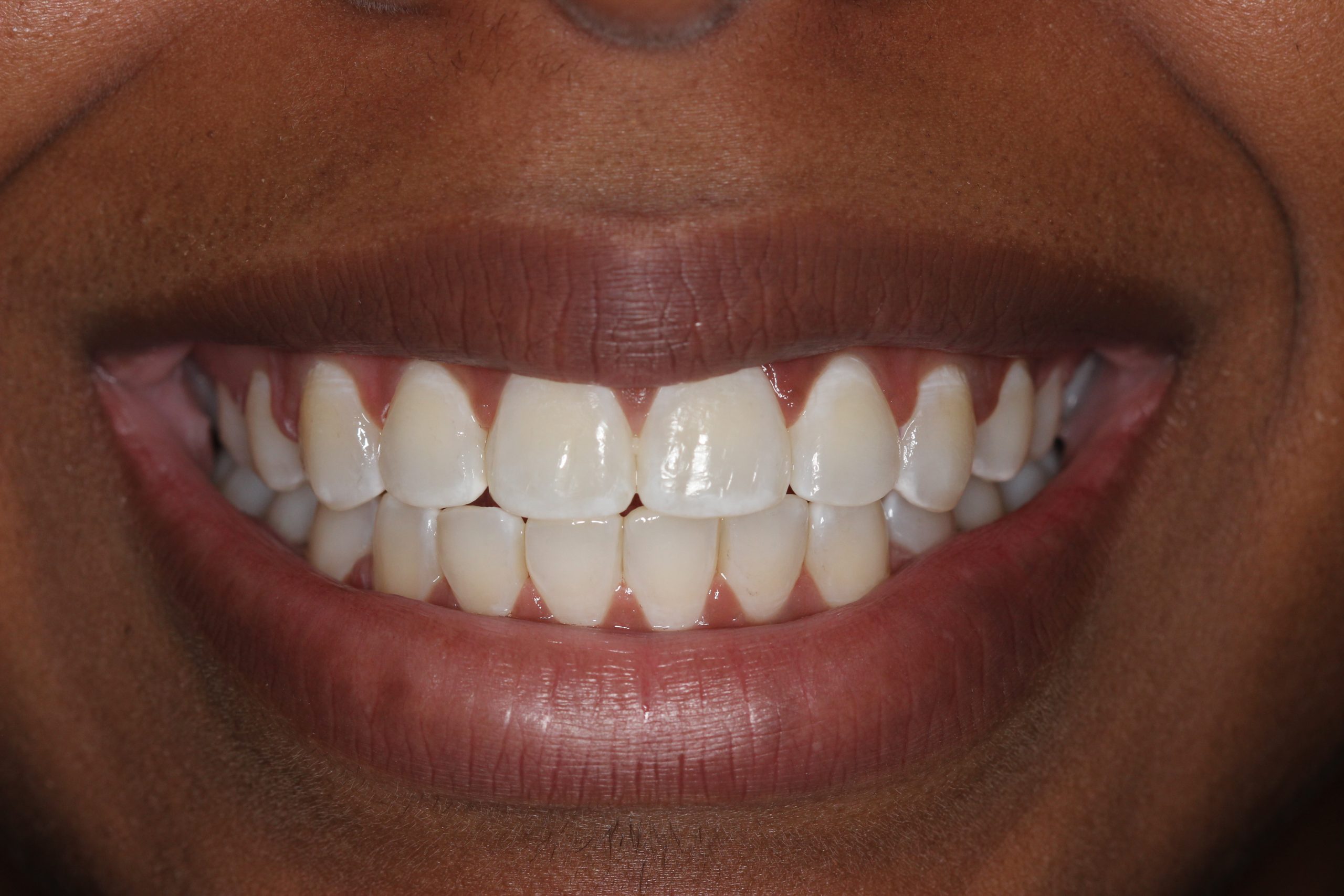 Patient's mouth after braces.