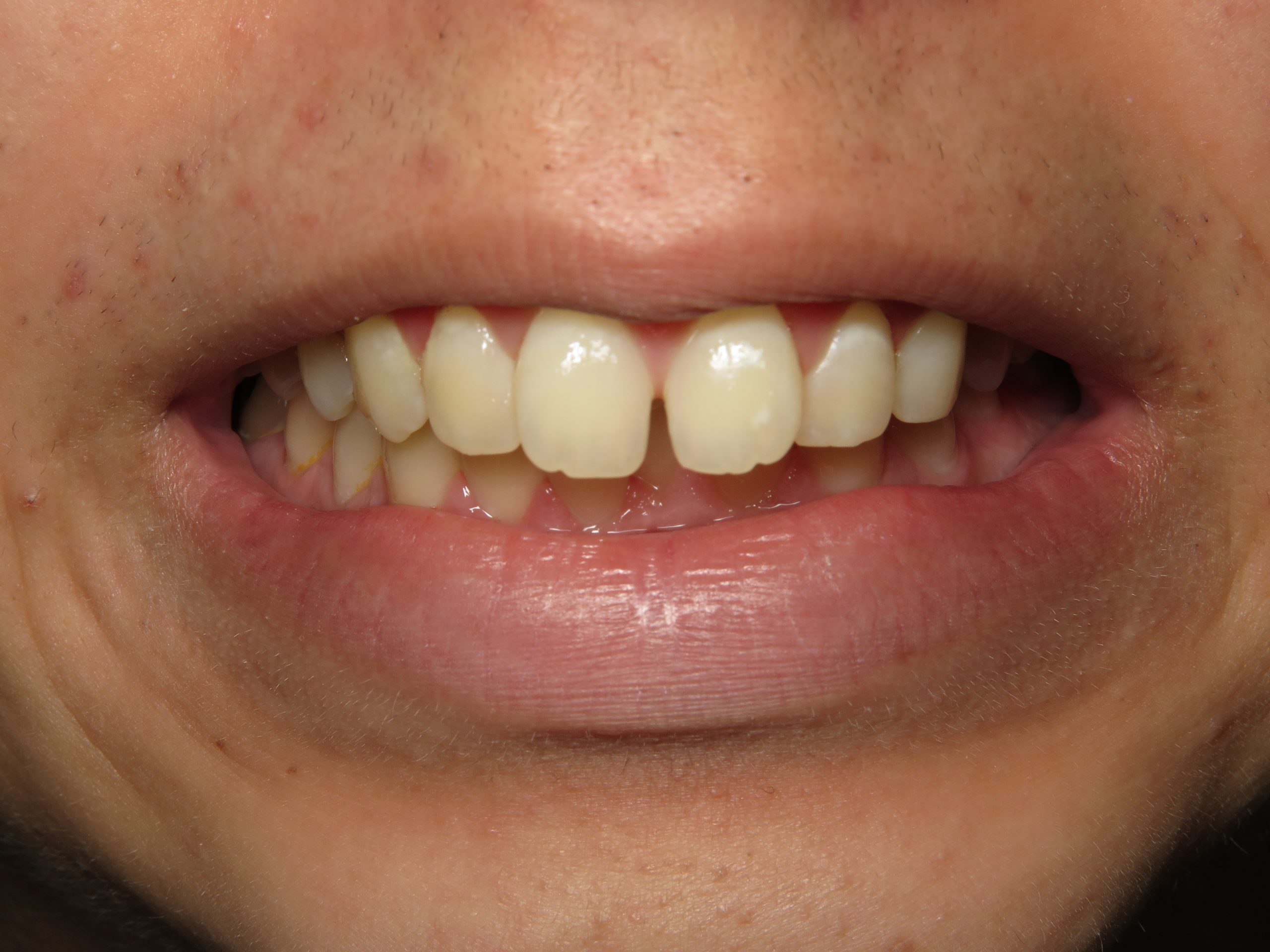 Patient's mouth before braces.