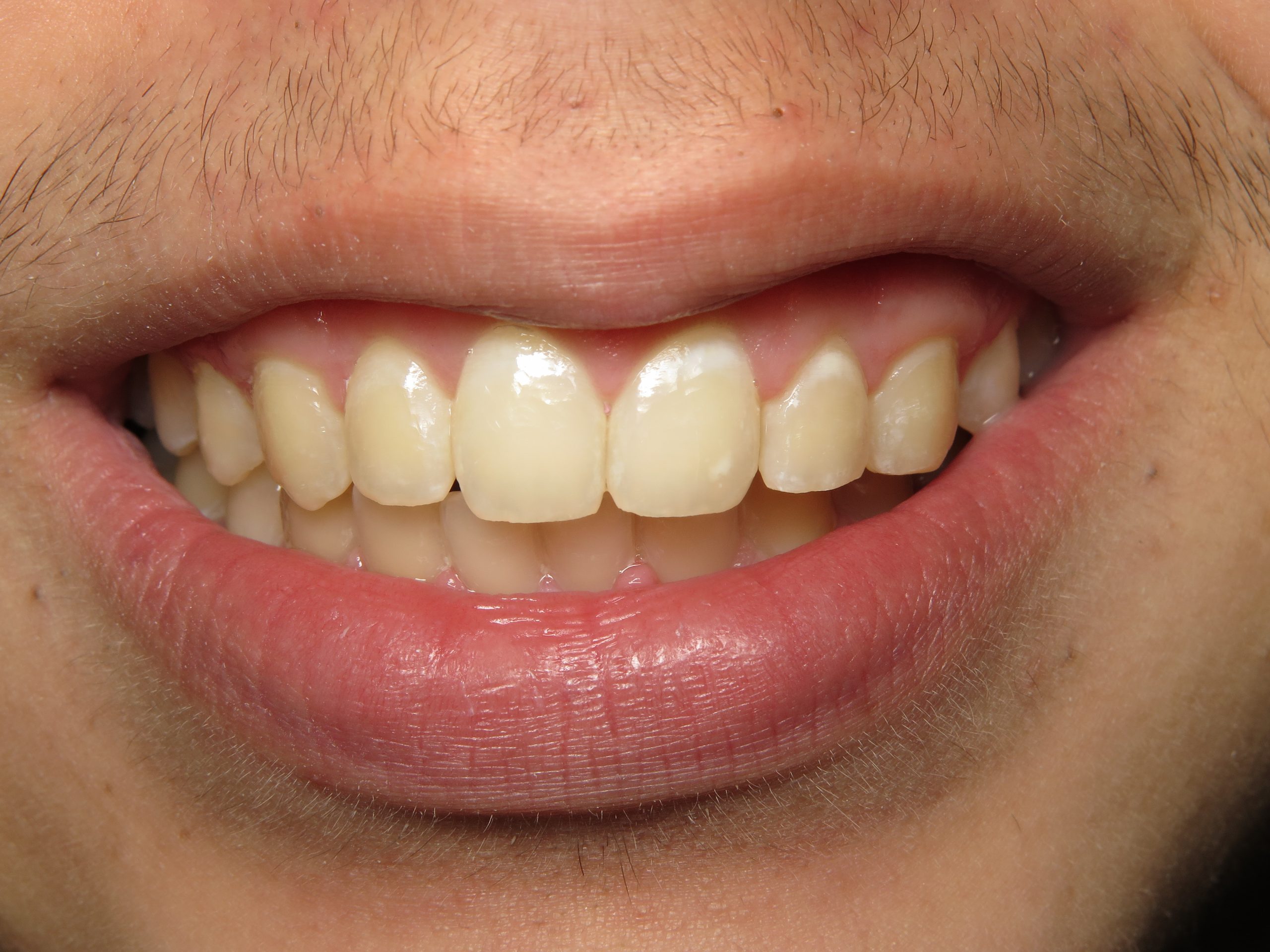 Patient's mouth after braces.