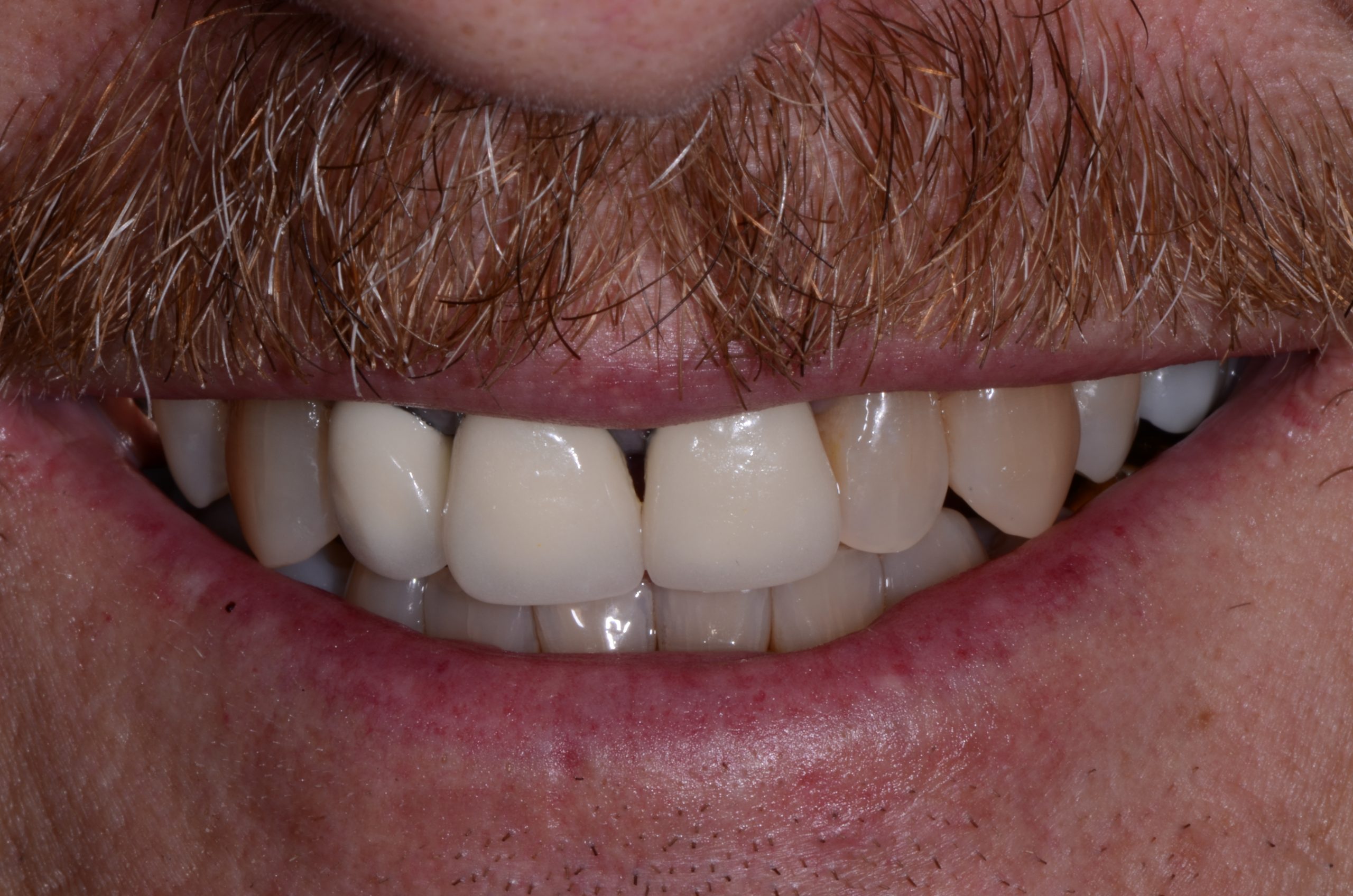 Patient's mouth before cosmetic dental care.