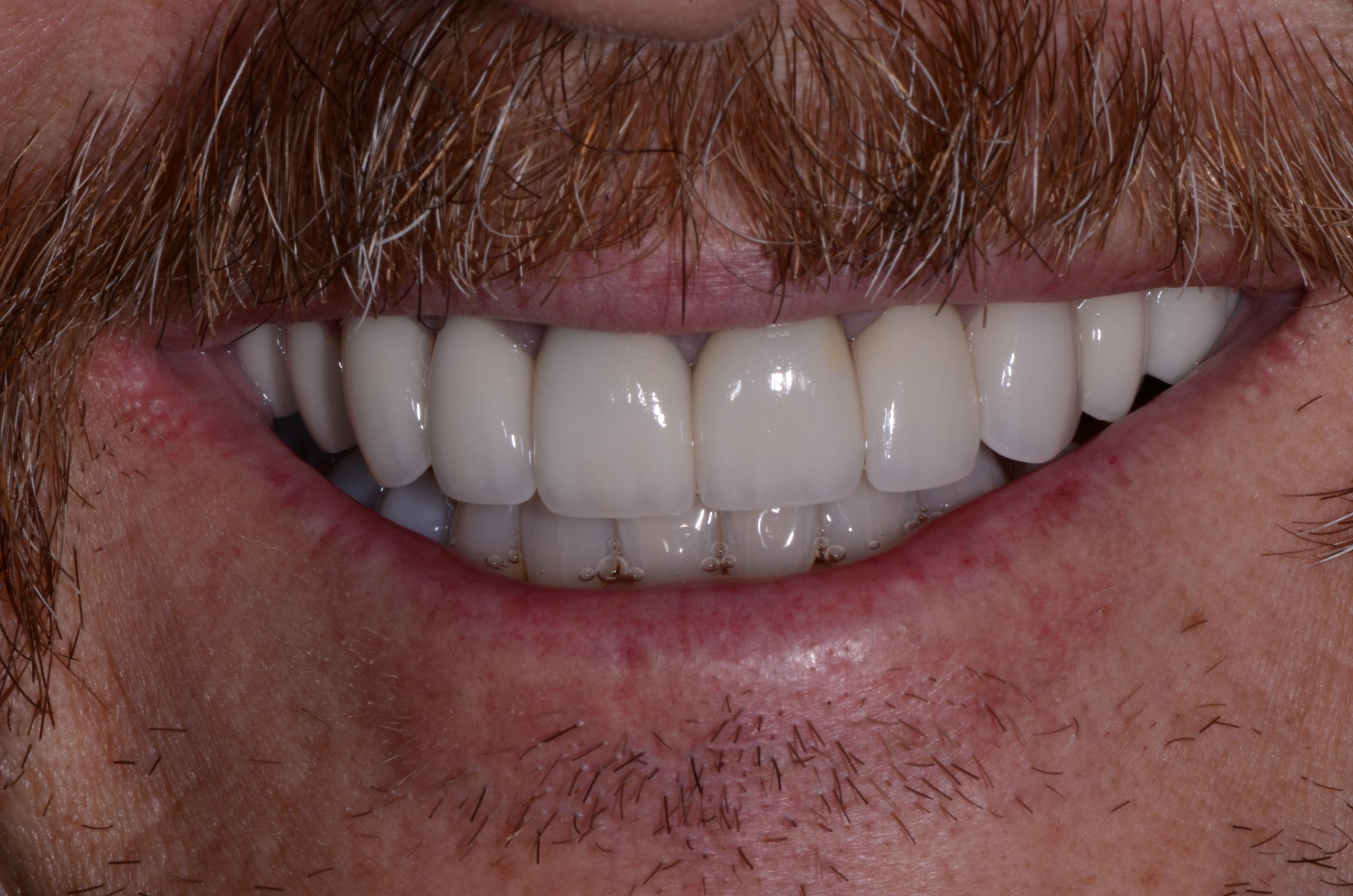 Patient's mouth after cosmetic dental care.