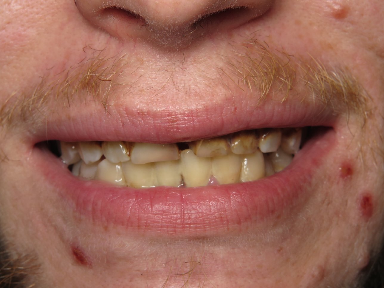 Patient's mouth before cosmetic dental care.