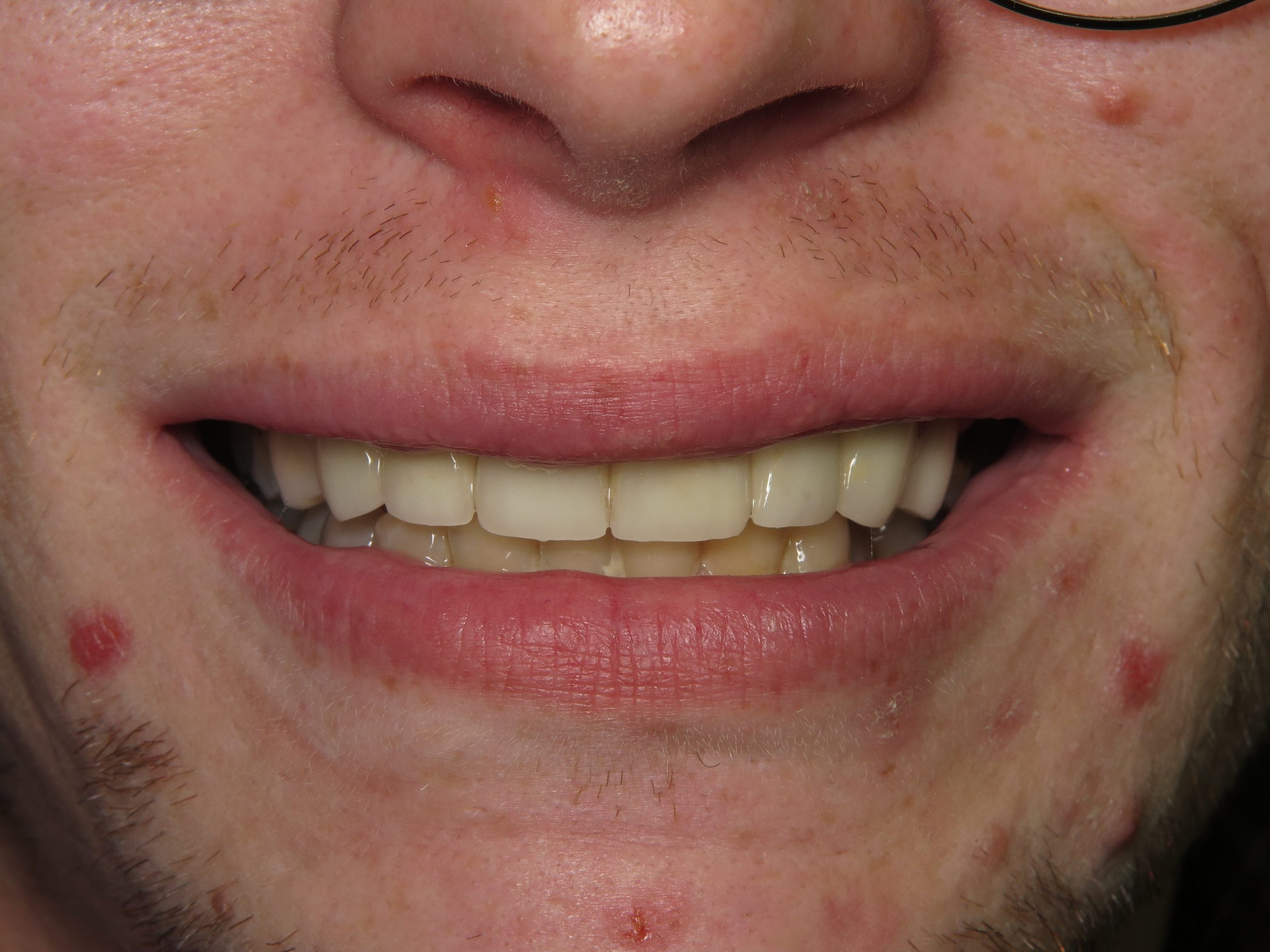 cosmetic-dental-after