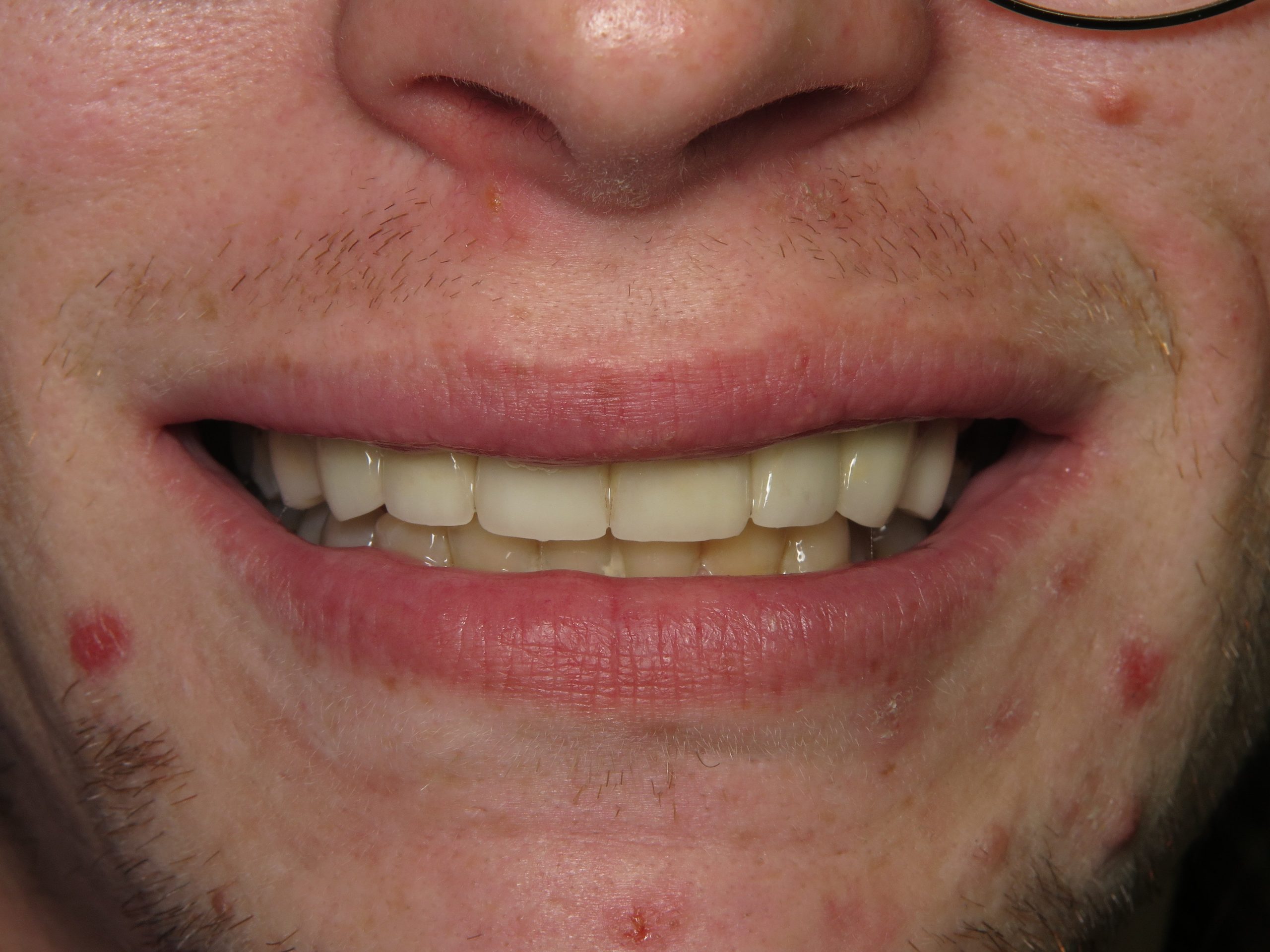 Patient's mouth after cosmetic dental care.