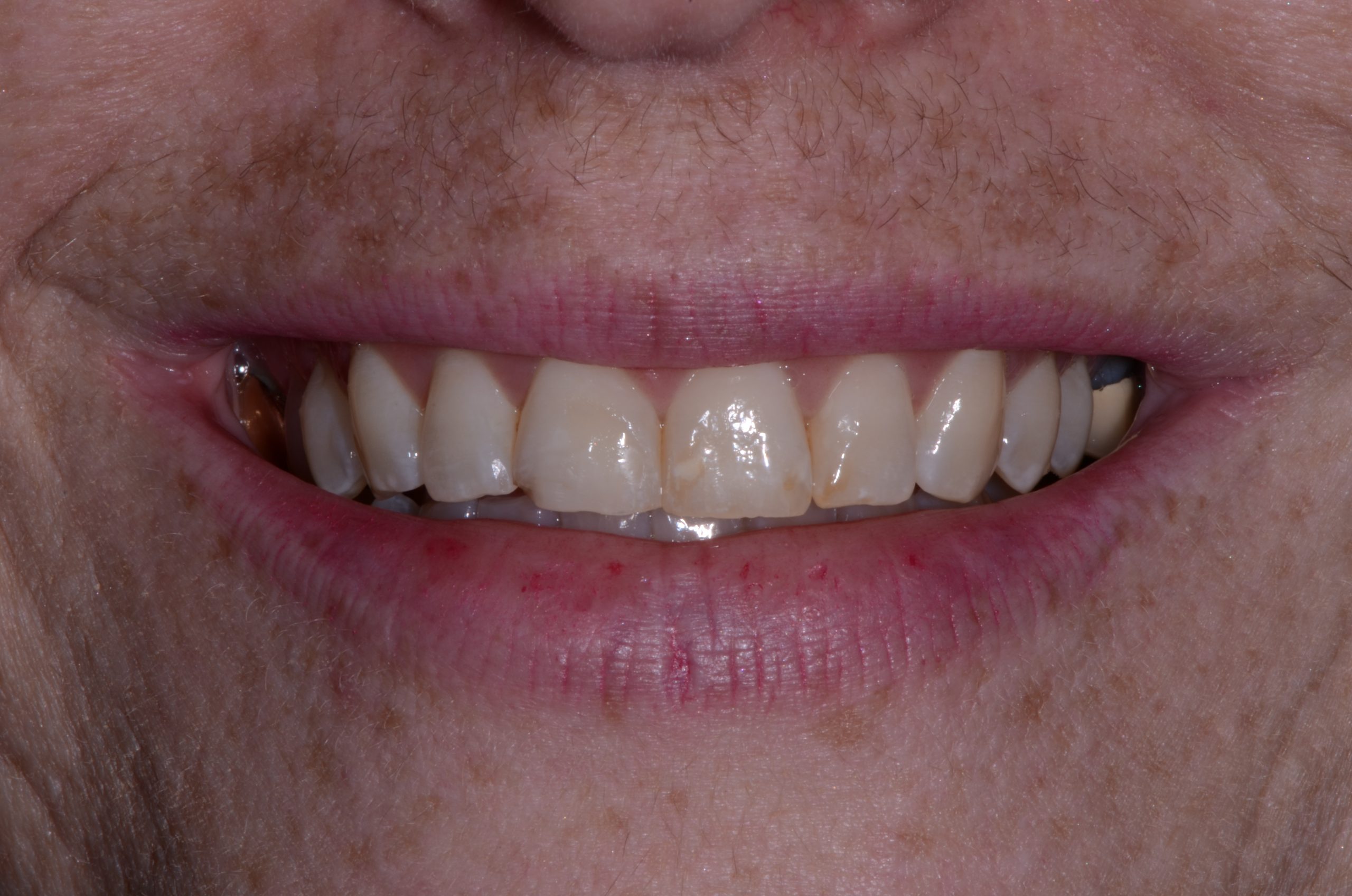 Patient's mouth before cosmetic dental care.