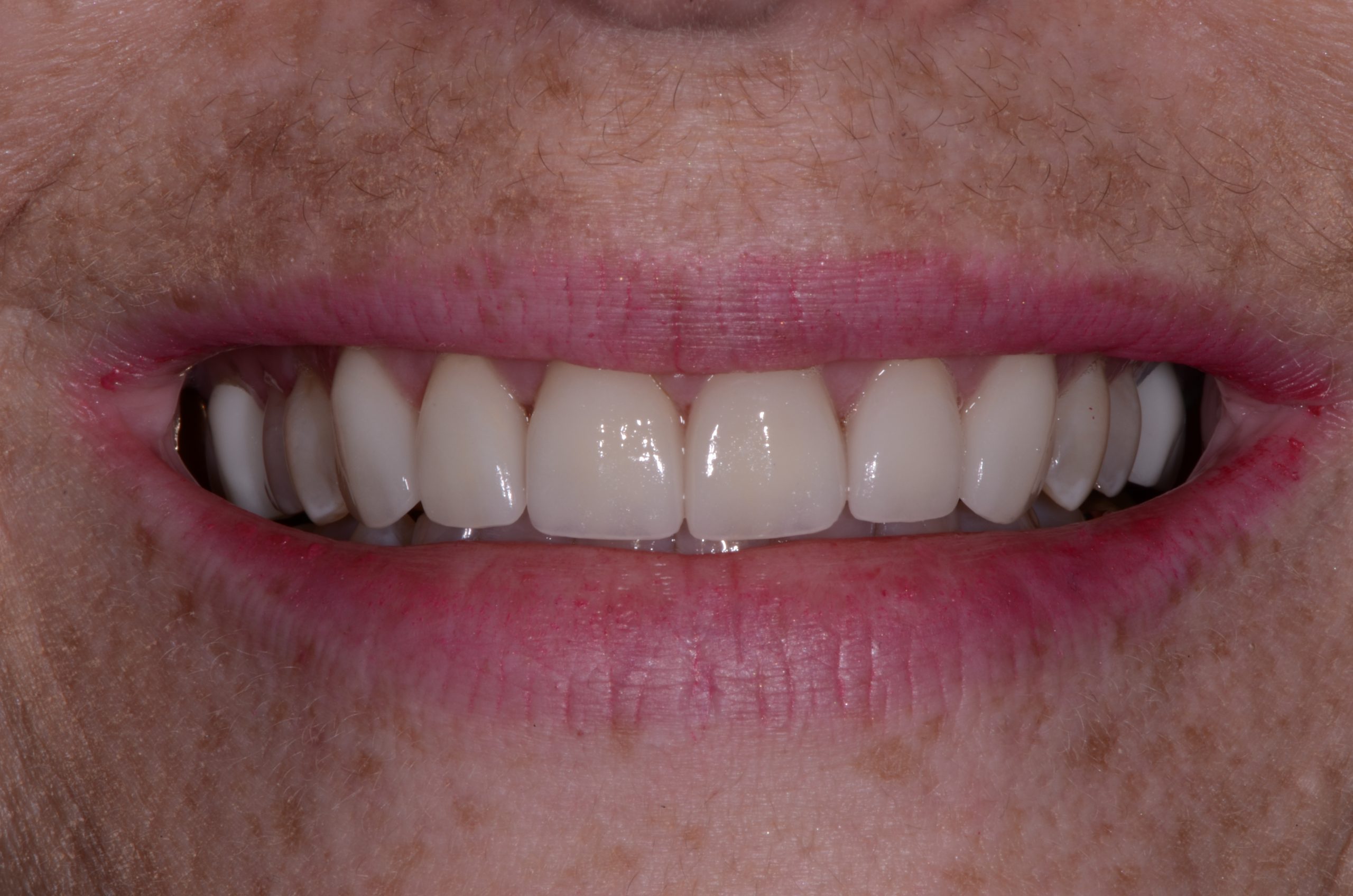 cosmetic-dental-care-after