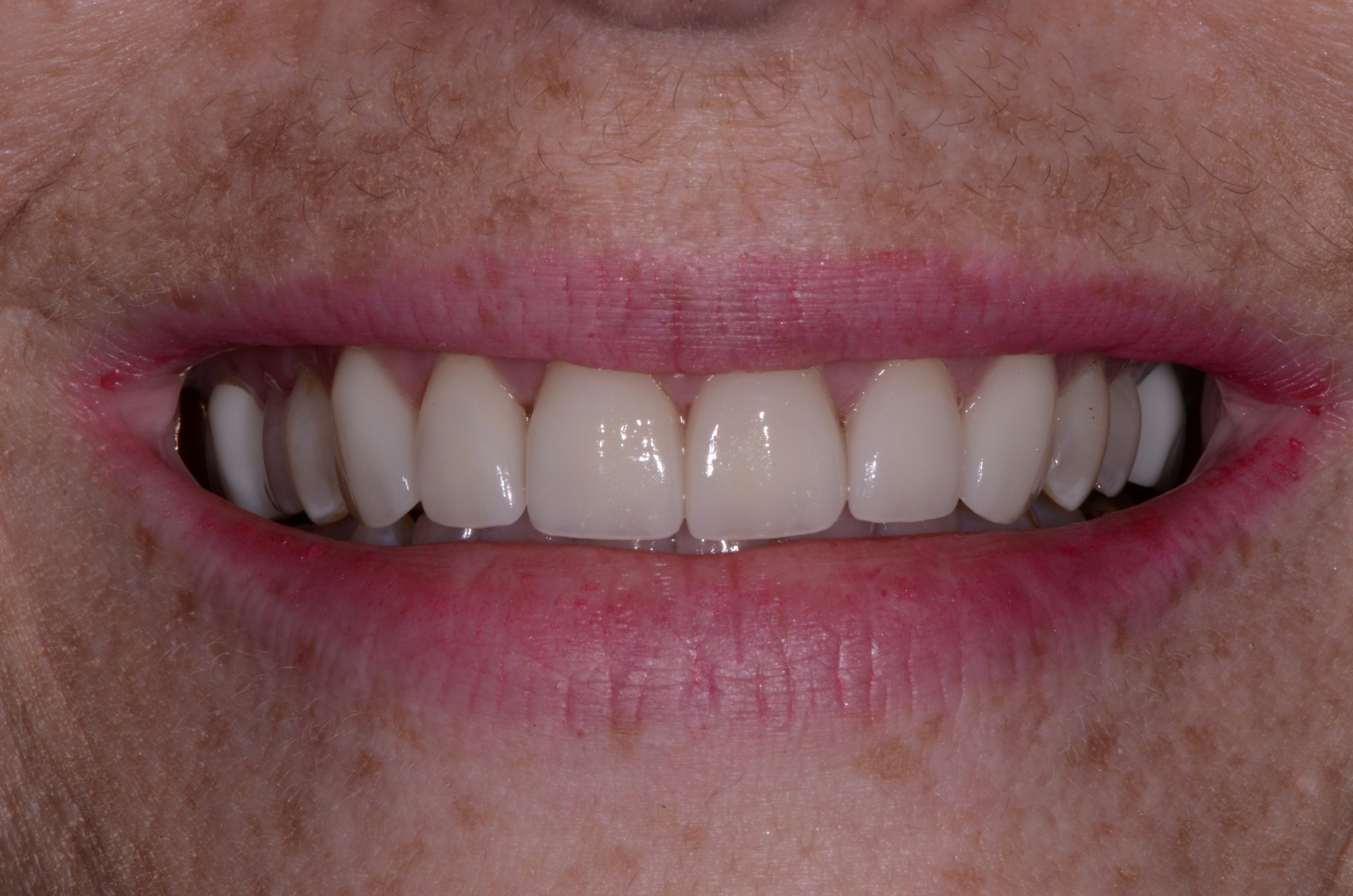 Patient's mouth after cosmetic dental care.