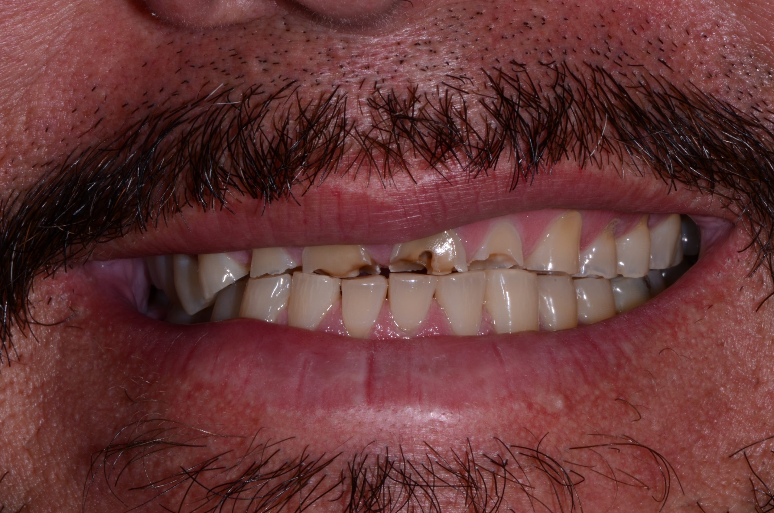before-dental-implants