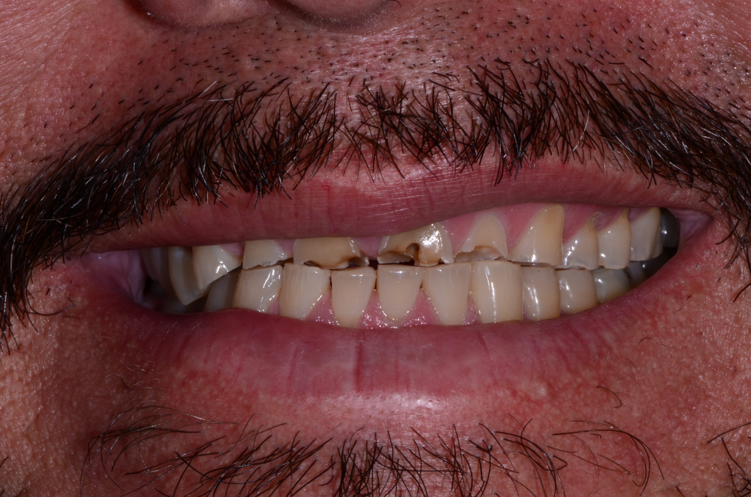 Patient's mouth before dental implants.