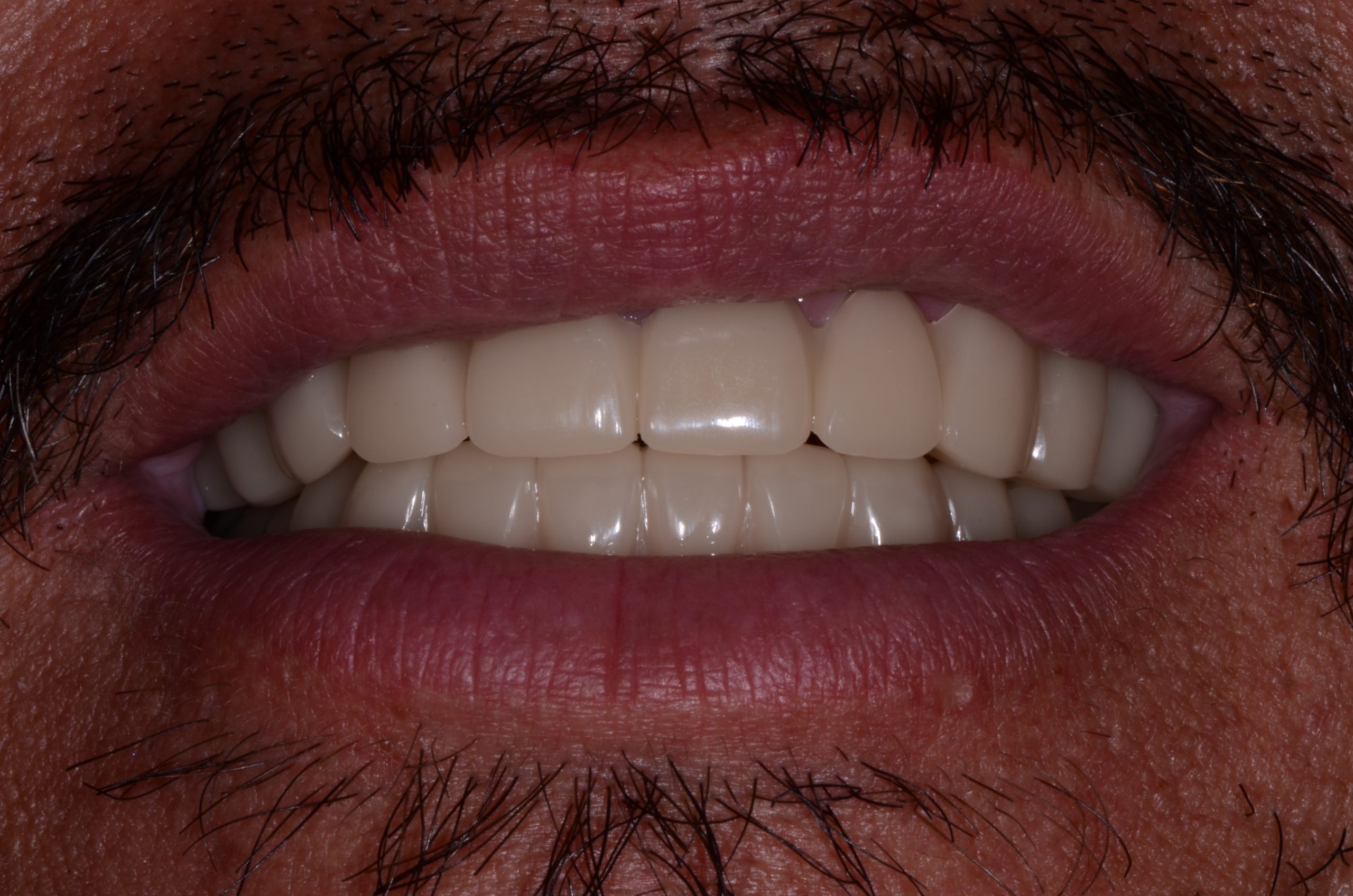 Patient's mouth after dental implants.