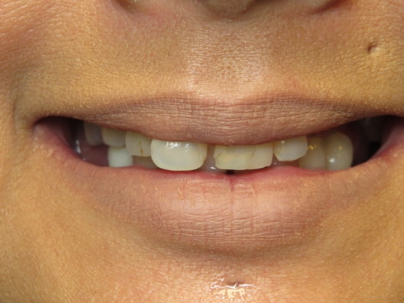 Patient's mouth before dental implants.