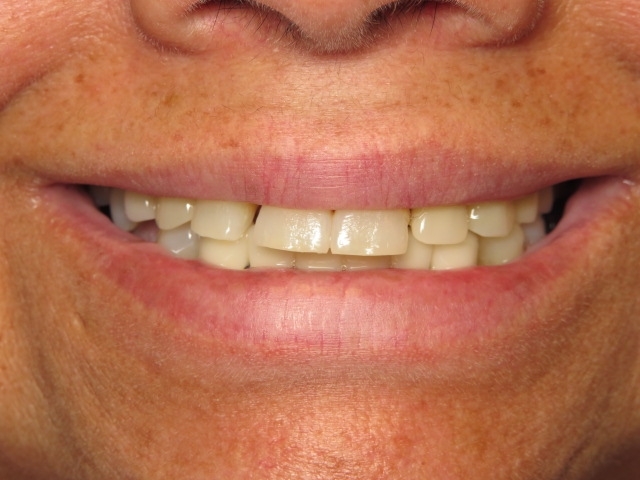 Patient's mouth before implants.