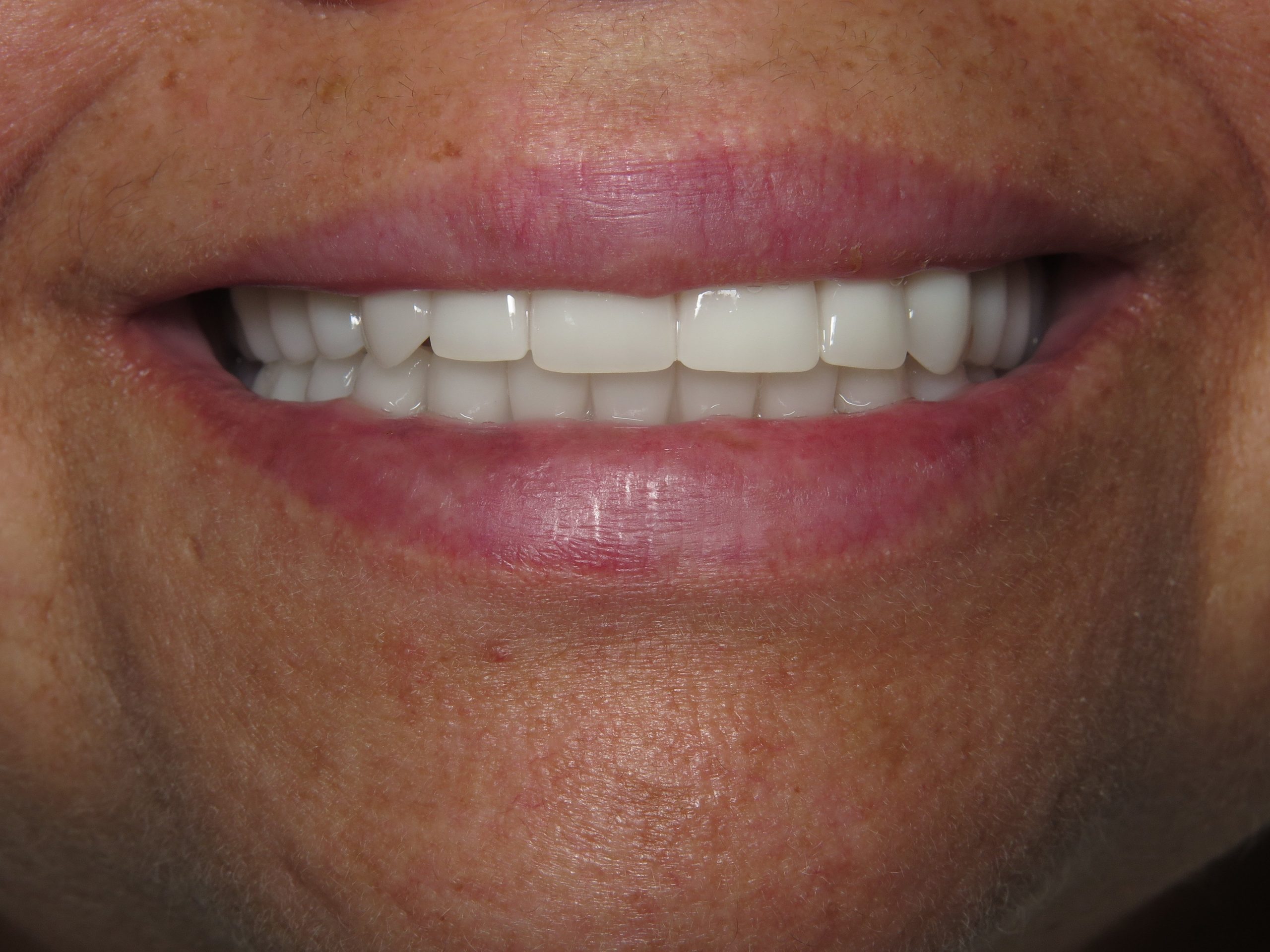 Patient's mouth after dental implants.