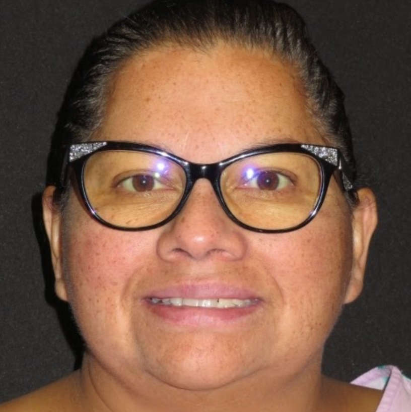 Woman with glasses before cosmetic dentistry photo